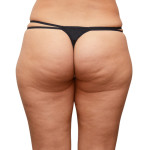 お尻から太ももへのセルライト　