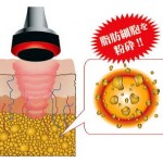健康快復センター江南のエステ痩身ではキャビテーションで脂肪を分解します。